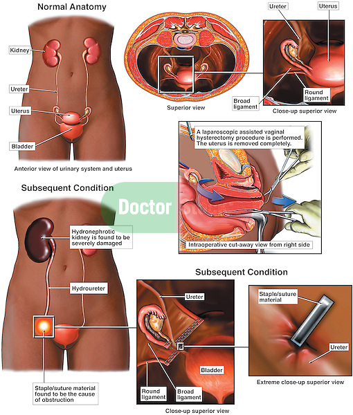uterus and regular abdominal hysterectomy It is important to get regular gynecologic exams since treatment is more effective when the cancer is found early your doctor may suggest a hysterectomy (removal of the uterus and possibly ovaries and fallopian tubes) abdominal hysterectomy. uterus and regular abdominal hysterectomy It is important to get regular gynecologic exams since treatment is more effective when the cancer is found early your doctor may suggest a hysterectomy (removal of the uterus and possibly ovaries and fallopian tubes) abdominal hysterectomy.